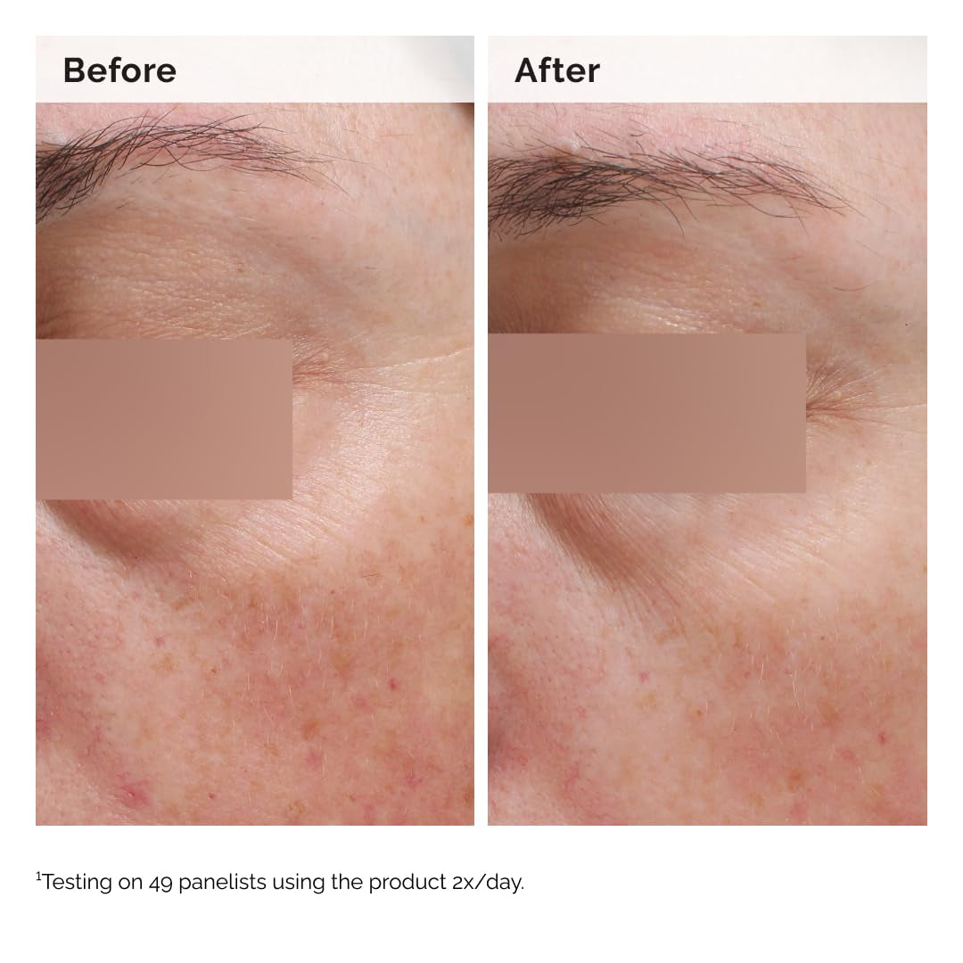 The Ordinary Niacinamide 5% Face and Body Emulsion, Dark Spot & Skin Tone Corrector, 3.4 Fl Oz
