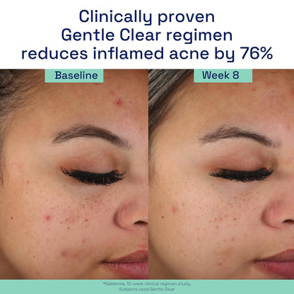 Gentle Clear Acne Face Wash, 2% Salicylic Acid, 4.2 Oz